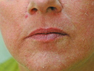 Restylane lip injections before 93361