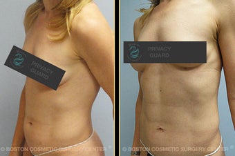 Vaser Liposuction before 561796
