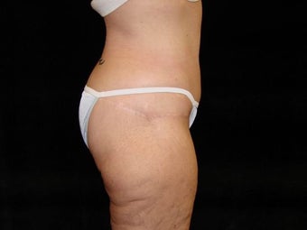 Body Lift with Liposuction of Abdomen, Waist, and Flanks after 203458