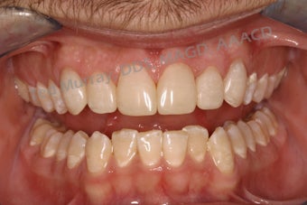 Direct Composite Resin Veneers 346958