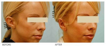 Otoplasty (Cosmetic Ear Pinning) before 136400