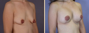 Breast Implants before 270008