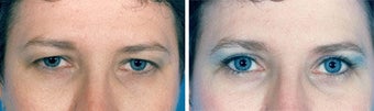 Blepharoplasty before 643242