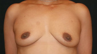 Breast Augmentation before 132249