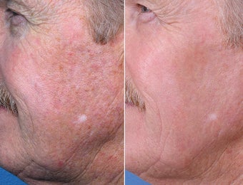 Evolence Chin and Smile Lines before 242557