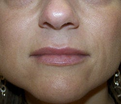 Juvederm after 87081