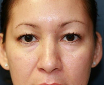Upper and Lower Eyelid Blepharoplasty before 326448