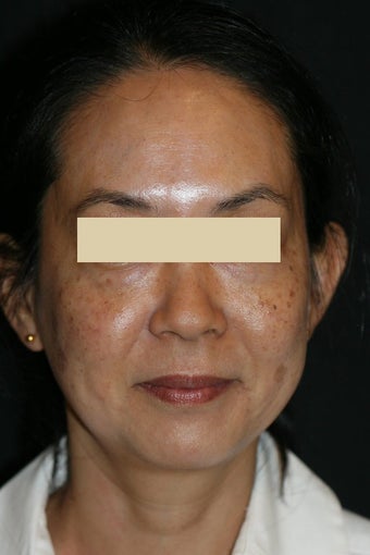 Fraxel Laser before 130147