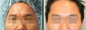 Endoscopic Brow Lift before 649383