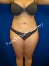 Liposuction after 632171