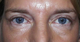 Upper Lid Blepharoplasty after 147715