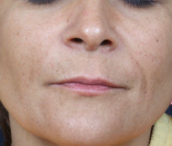 Radiesse treatment for nasolabial folds after 124912
