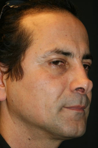 Male Rhinoplasty Revision before 428237
