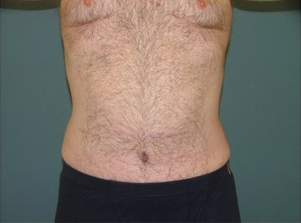 Tummy Tuck after 97007