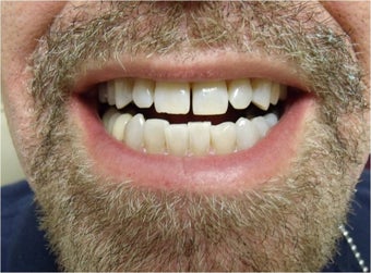 Zoom! Laser Whitening after 365946