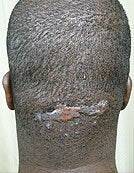 Surgical Treatment of Acne Keloidalis Nuchae before 196059