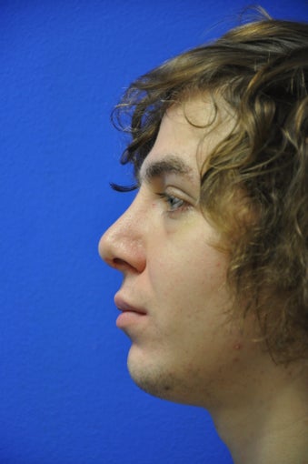 Rhinoplasty (correction of nasal vestibular stenosis/septoplasty) 533839