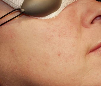 Vein Treatment after 135895