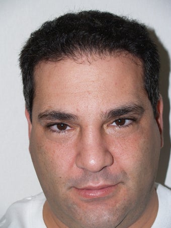 Hair Transplant- 2800 grafts after 173707