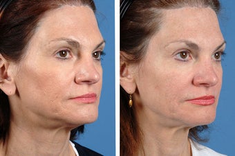 Fillers and Botox Cosmetic 356475