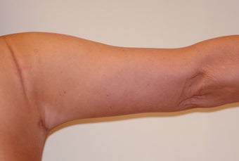 Brachioplasty (Arm Lift) After Massive Weight Loss (Posterior View) after 65366