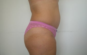 Abdominoplasty after 607511