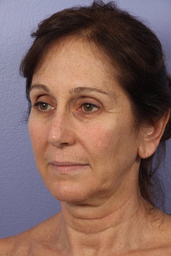 53 yr old Face and Necklift before 622095