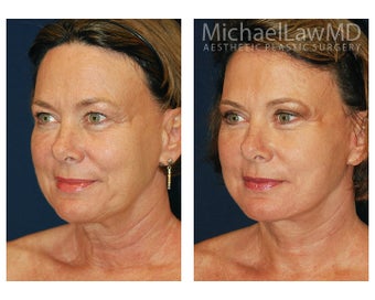 Facial Rejuvenation after 395488