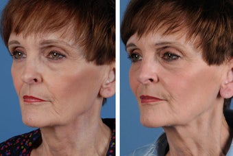Juvederm Plus 356494