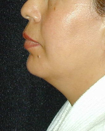 Chin Implant after 101324