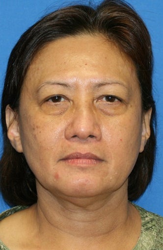 Upper Blepharoplasty,Lower Blepharoplasty, and Lower Eyelid Skin Pinch before 476840