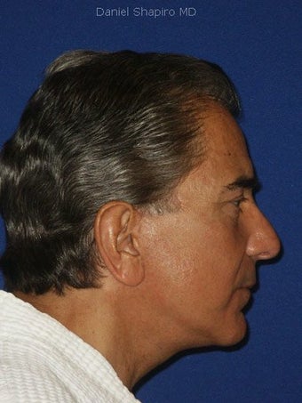Facelift, Endoscopic Browlift, Upper and Lower Blepharoplasty with canthopexy after 249293