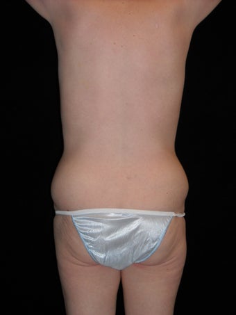 Body lift after weight loss before 414434