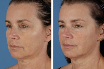 Radiesse & Botox Cosmetic 356479