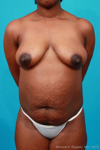 Mommy Makeover: Breast Lift & Extended Abdominoplasty before 252328