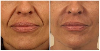 Restylane before 337255