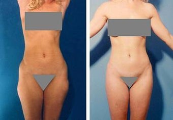 Liposuction before 636224