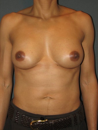 Bilateral Breast Augmentation with Silicone Gel Implants after 472900