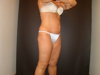 CoolSculpting 572381