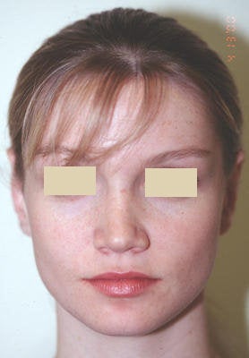 Otoplasty after 66684