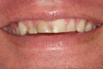 Porcelain Veneers before 213076