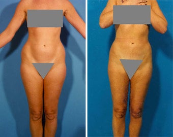 Liposuction before 636111
