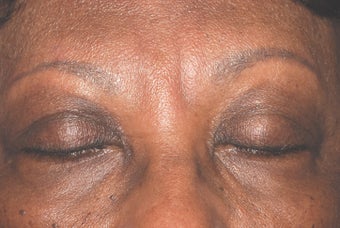 Botox for frown lines after 119388