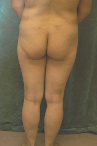 Women's Buttocks Augmentation 518113