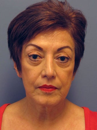 Neck Lift, Platysmaplasty before 634750
