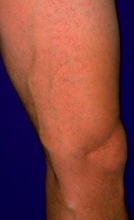 Sclerotherapy before 370423