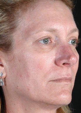 Sculptra Aesthetic before 375291