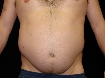 Liposuction of Abdomen, Waist, Flanks, Pecs, and 6 Pack Abdominal Etching before 203543