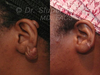 Keloid Removal before 563910