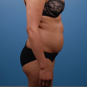 Liposuction before 207569